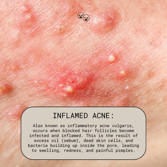 What Is Inflamed Acne?